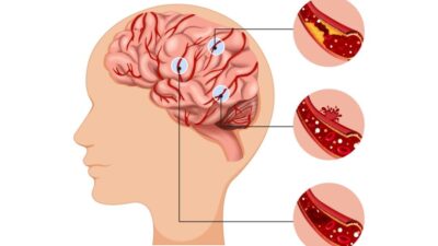 Dampak Sistem Rujukan Terhadap Pasien Stroke di Indonesia Dampak Sistem Rujukan Terhadap Pasien Stroke di Indonesia